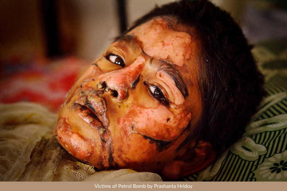 Victims-of-Petrol-Bomb-by-Prashanta-Hridoy